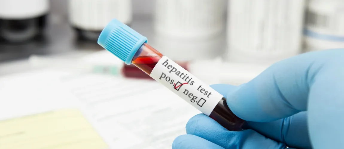 Hepatitis Test im Labor - Schutz vor HepatitiInfektion