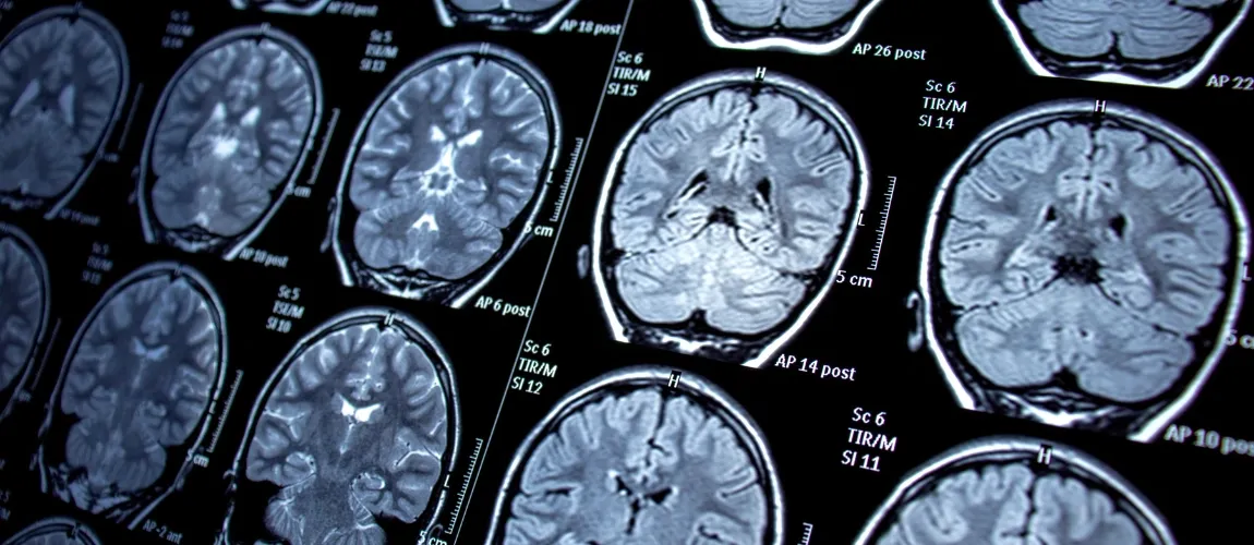 Epilepsie Aufnahmen Gehirn Symptome